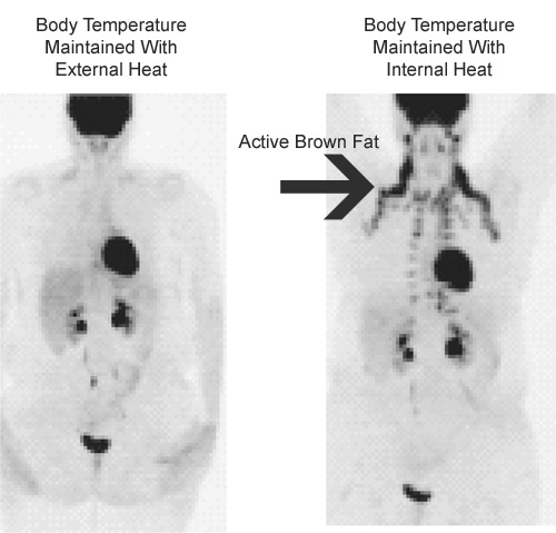 Active Brown Fat Image